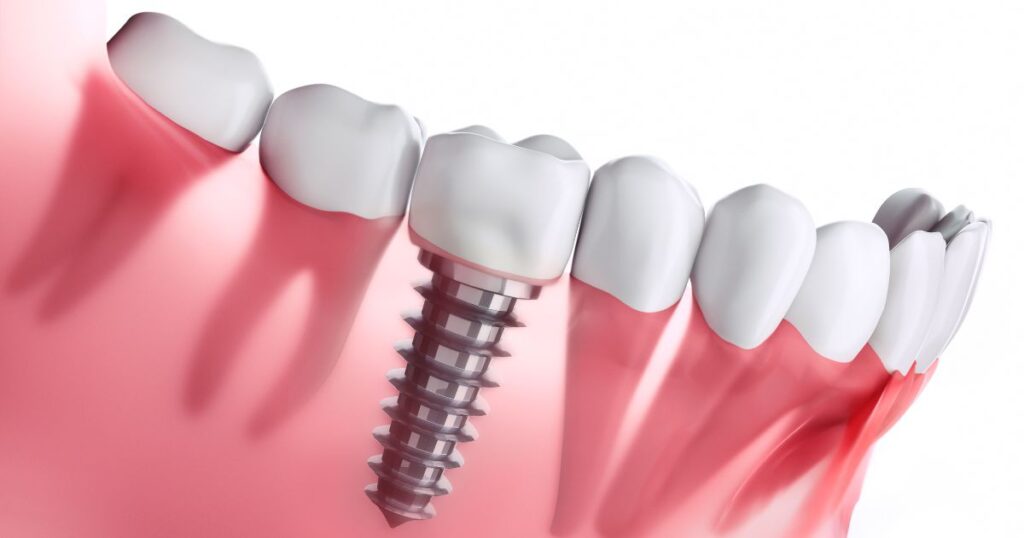 Zubné implantáty vám vrátia úsmev