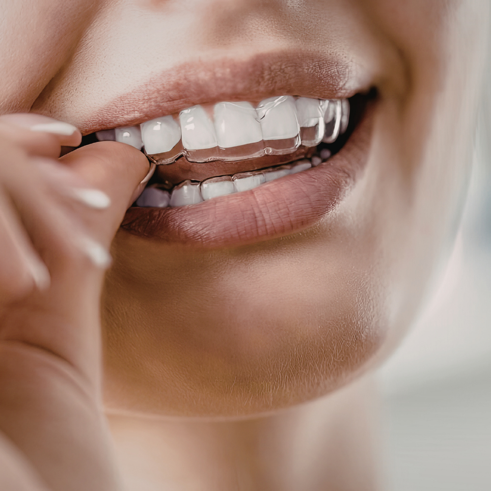 Žena si nasadzuje priehľadný strojček, zuby na splátky MedDent Prievidza