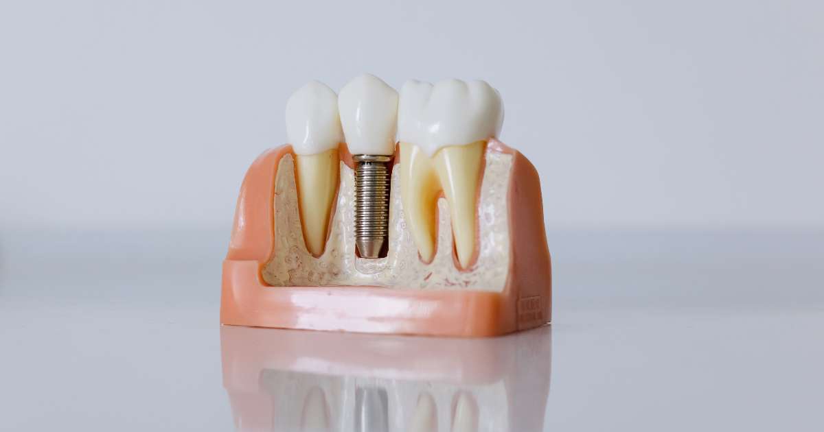 Zubný implantát